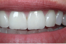 Composite Veneer After