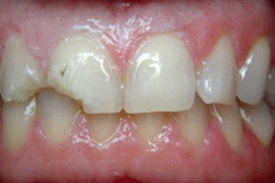 Composite Veneer Before