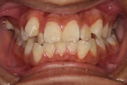 Crooked Teeth