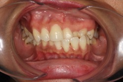 Crossbite