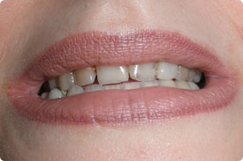 Crown Restoration