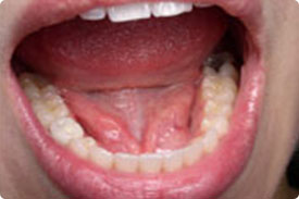 Dental Implant - After