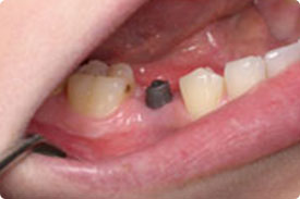 Dental Implant - Before