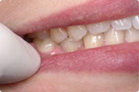 Dental Implant - After