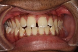 Gap teeth