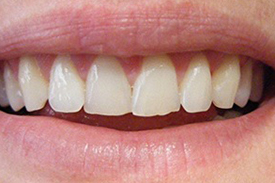 Gum Contouring After