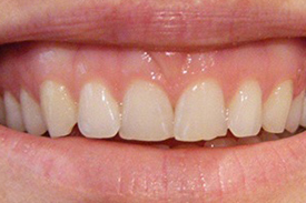Gum Contouring Before