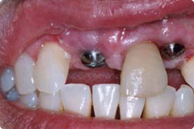 Dental Implant - Before