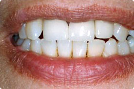 Dental Implant - After
