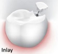 Inlay
