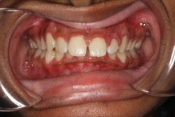 Overjet teeth