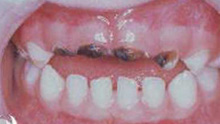 Paediatric - Teeth Problem