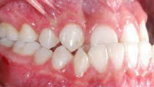 malocclusion