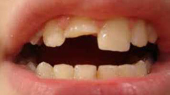 Trauma Teeth