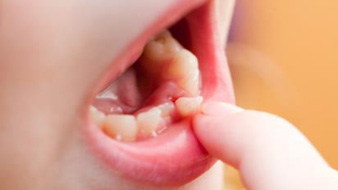 Trauma Teeth