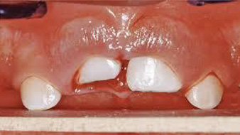 Trauma Teeth