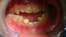 Paediatric - Teeth Problem