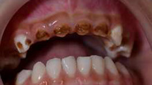 Caries