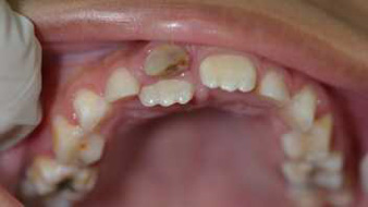 retained milk teeth