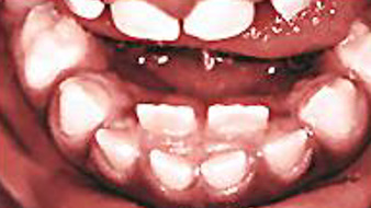 retained milk teeth