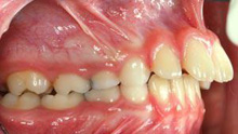 malocclusion