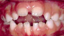 malocclusion