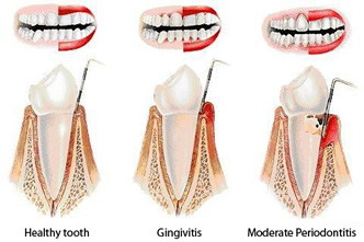 Periodontal Disease