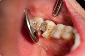 Periodontal Disease