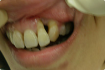 gum surgery