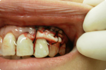 gum surgery
