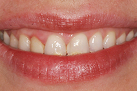 Porcelain Veneer Before