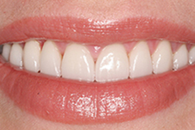 Porcelain Veneer After