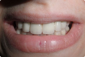 Crown Restoration
