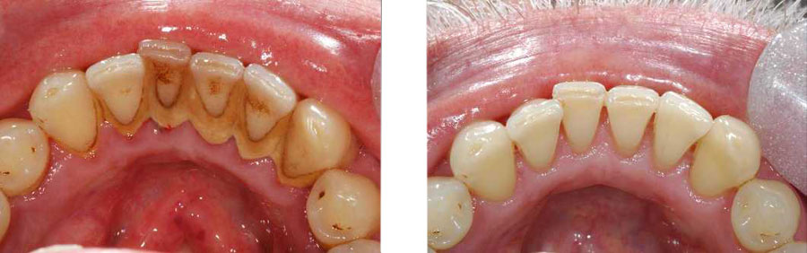 scaling and polishing