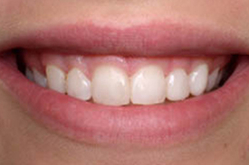 Teeth Bonding After