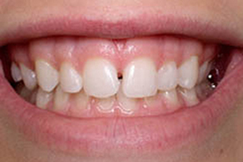 Teeth Bonding Before