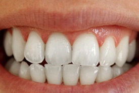 Teeth Whitening After