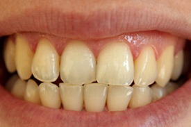 Teeth Whitening Before