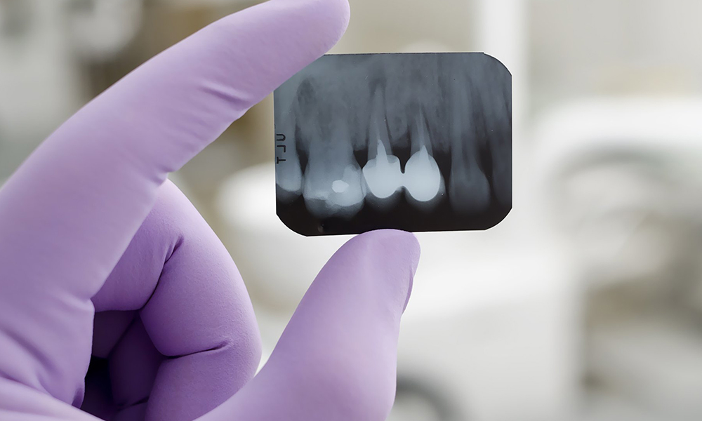 Dental Xray