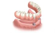 Implant Supported Denture