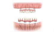 Implant Supported Denture