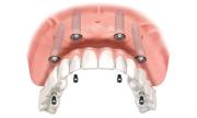 Implant Supported Denture