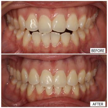 Invisalign