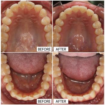 Invisalign